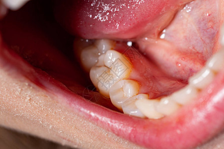 在牙医办公室临时填充牙医为治疗牙龈炎而设图片