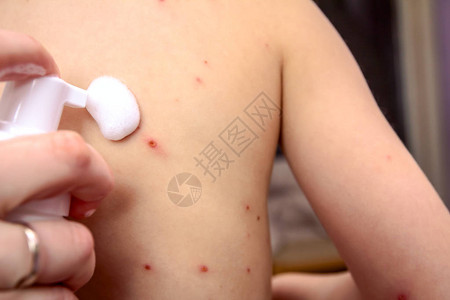 受天花感染的儿童皮肤正在使用抗消毒图片