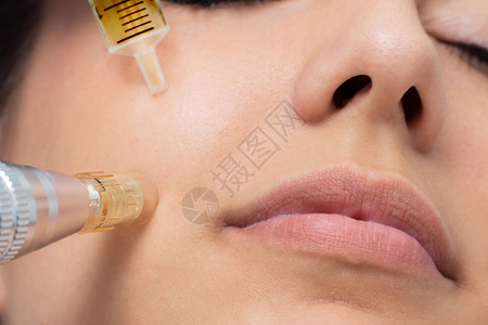在女脸颊上用微型针头化妆品治疗的宏观细节图片