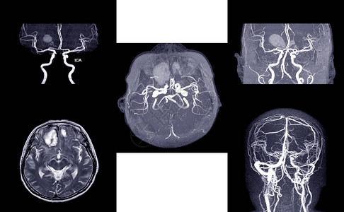 BRAIN的MRA和MRV图片