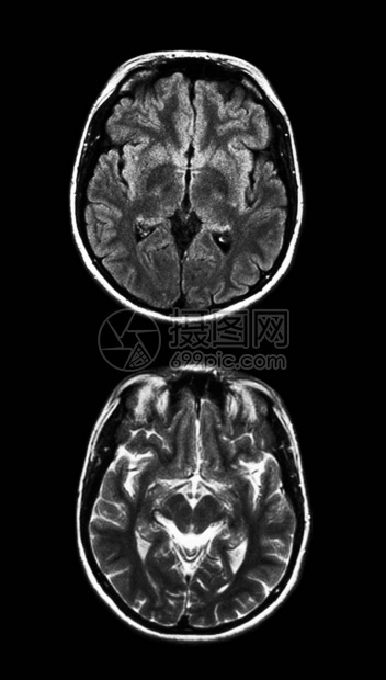 黑色大脑MRI扫描图片