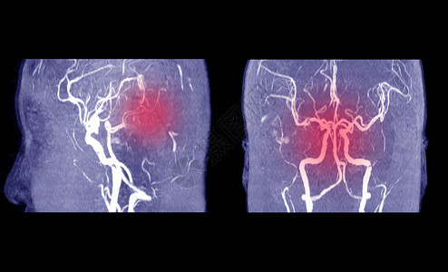 MRA脑或动脉磁共振血管造影与habd医生指出脑内血管异常医背景图片