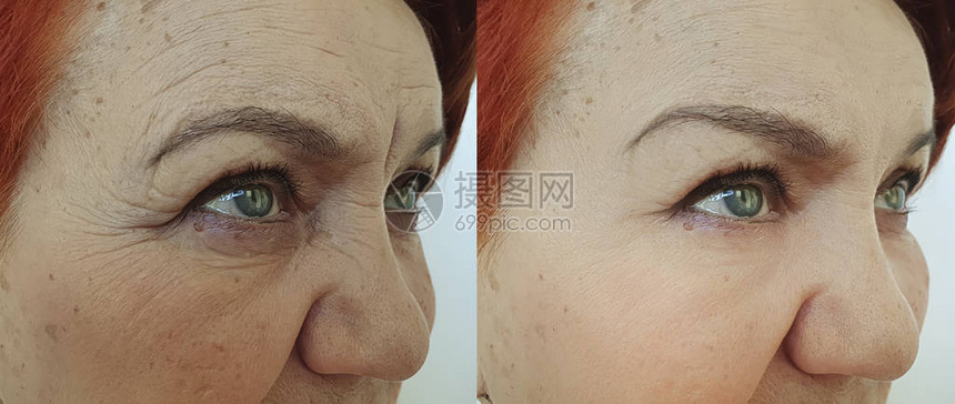老妇人在治疗前后皱纹脸上图片