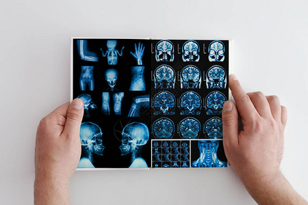 手拿着病人的头部颈部和大脑的MRI扫描图片