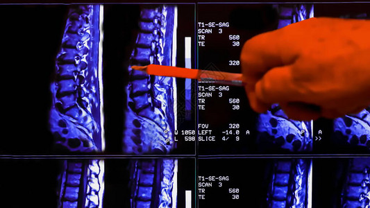 医生分析患有慢背痛的患者脊柱的磁共振成像结果MRI显示脊柱退行变化腰椎间盘突出背景图片