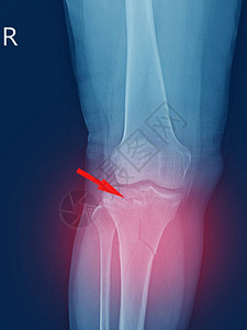 线膝关节胫骨近端干骺端骨折胫骨外侧平台凹陷骨折红点软组织严重肿胀图片