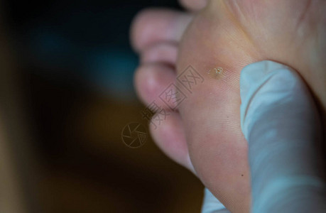 近距离拍摄一个长疣的高加索人的脚手的指检查感染区图片