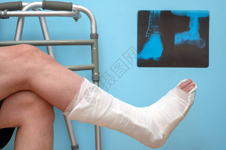 蓝色背景上有断腿的男人的腿踝关节骨折踝关节骨折的X射线图像图片