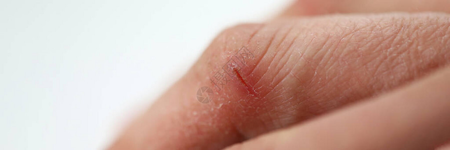 人手切割的特写镜头干裂的皮肤手指上的伤口和裂缝皮肤病受了轻伤手部护肤品皮肤病背景图片