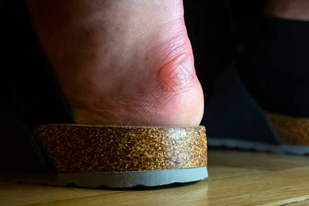 脚后跟有可怕的膀胱疼痛的脚上的水泡皮肤新鞋造成的图片