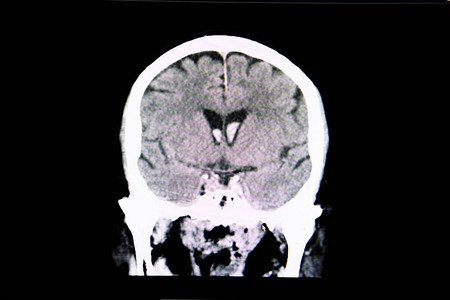 出血中风颅内出血患者大脑的CT扫描在侧图片