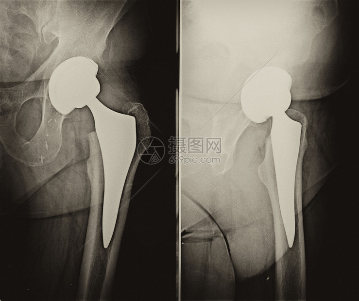 将假肢植入人臀部的操作放射线学图片