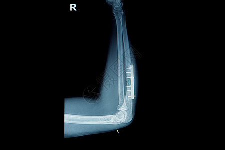 胶片X射线手腕骨折图片
