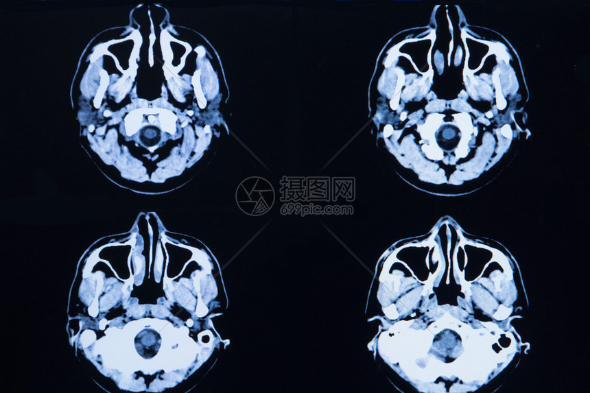 来自大脑和头骨的计算机断层扫描的图像图片