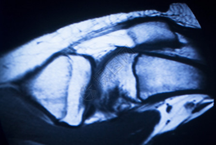 MRI磁共振成像医学扫描测试结果显示膝关节半月板股骨大腿和小腿韧带软骨和人体骨骼背景图片
