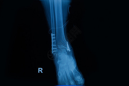 收集显示右腿骨折两根骨头折图片