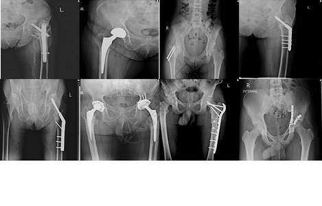 X线采集骨科手术多髋关节手术和钢板内固定和螺钉内固定图片