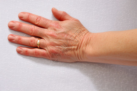 帕金森氏症指甲前臂高清图片