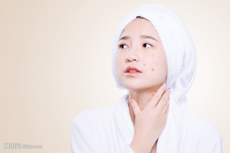 女孩脸上的痤疮