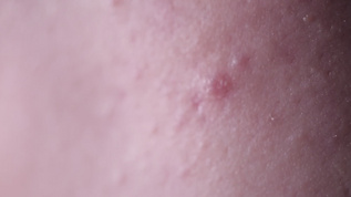 皮肤问题痤疮长痘痘印视频素材