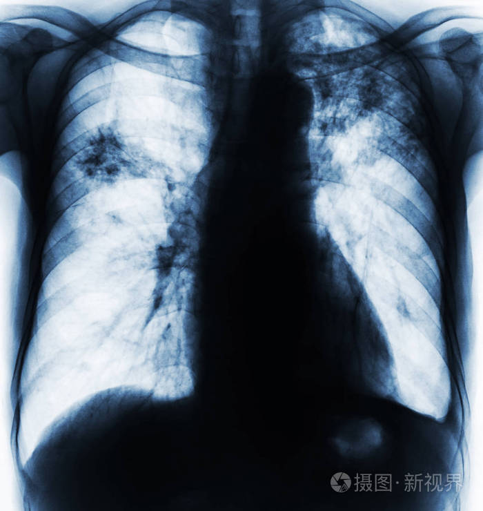 肺结核.胸部 x 光胶片显示纤维化,间质浸润由于结核杆菌感染两肺