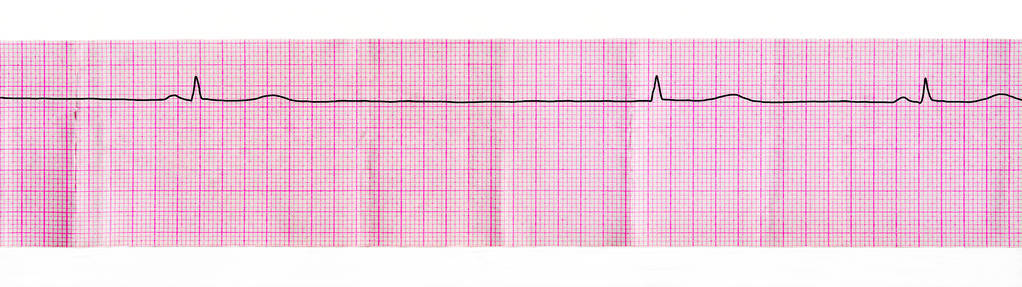 Ecg 磁带与停止的窦房结和房室交界区从复杂更换