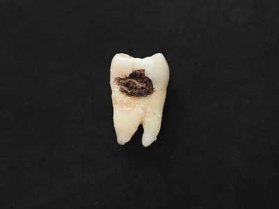 黑色背景上有龋齿大孔的单牙差。不健康的牙齿
