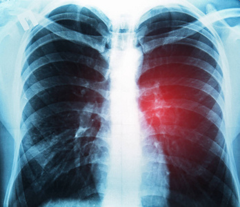 胸部 x 光图像。肺癌概念