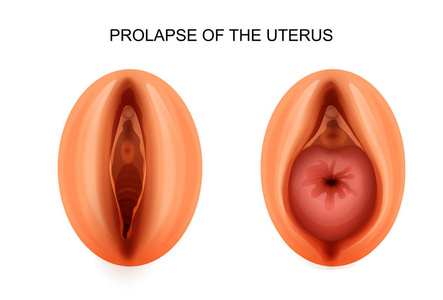 子宫脱垂。妇科