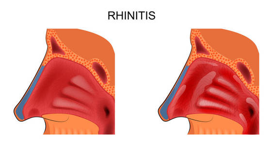 鼻腔粘膜的炎症。变应性鼻炎