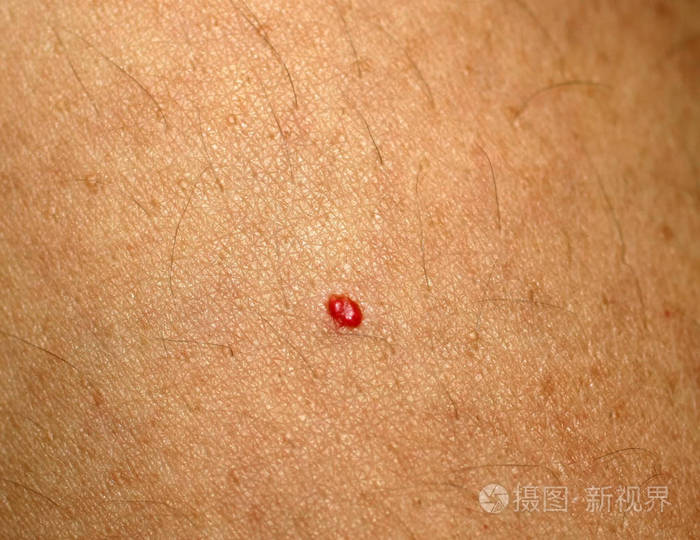 血管瘤.身体上的红痣.在皮肤上的胎记