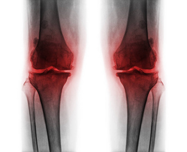 两个膝关节骨性关节炎