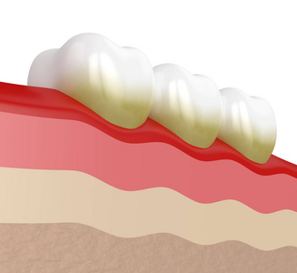 3d. 牙斑和牙垢的牙齿呈现