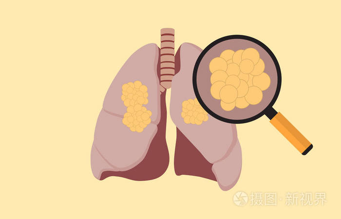 肺癌与肿瘤细胞在肺和放大镜