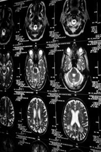 人脑ct扫描的非常清晰的图像