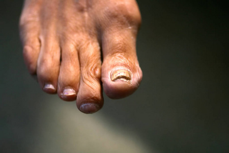 在钉子上的真菌。扭曲的手指在老茧的脚上。上大脚趾骨