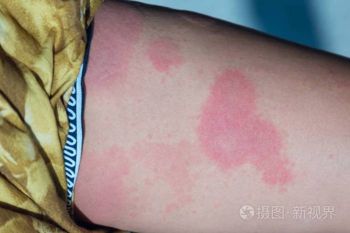 女性腿部荨麻疹