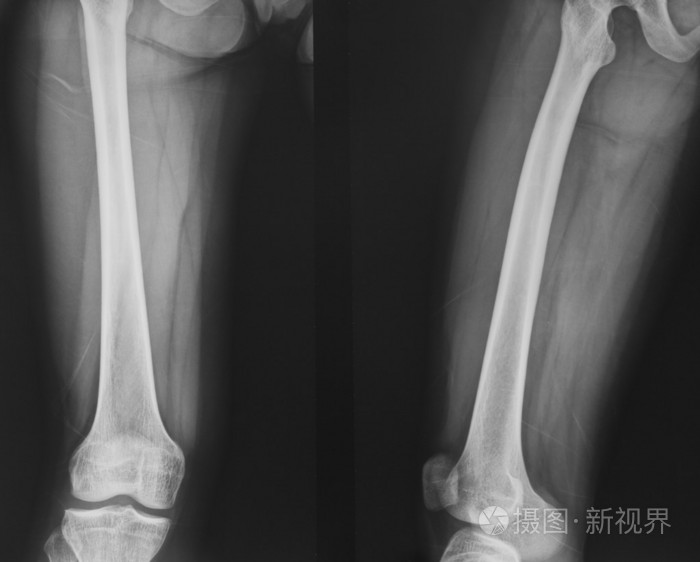 正常膝关节x线采集