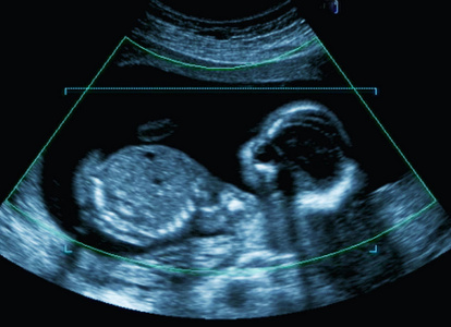 妊娠期母亲子宫超声的医学图像