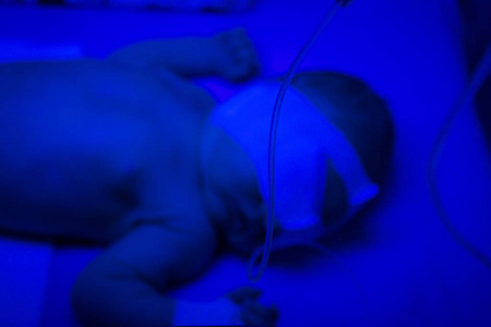 不明新生儿接受紫外线光疗黄疸