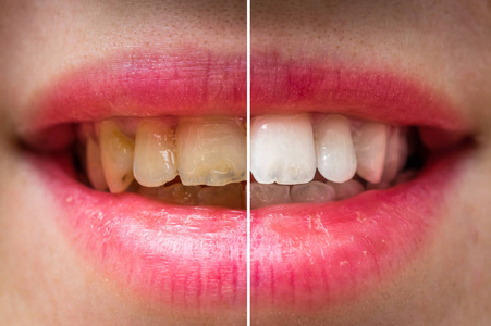 牙科治疗前后的妇女牙齿