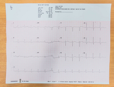 心脏分析心电图ECG