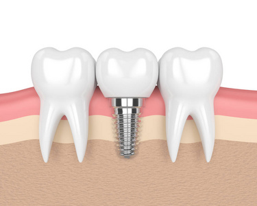 3d 牙齿植入牙在牙龈中的呈现