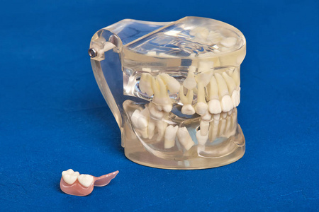 植入物，牙齿矫正牙齿正畸牙颌模型