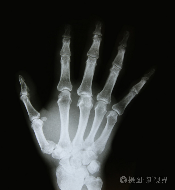 手臂的骨头的 x 射线图像