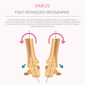 脚变形作为医疗疾病图表。外翻和 varu