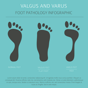 脚变形作为医疗疾病图表。外翻和 varu