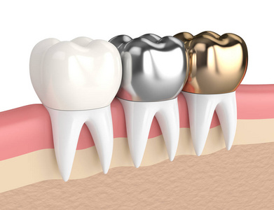 3d. 不同类型牙冠牙的渲染