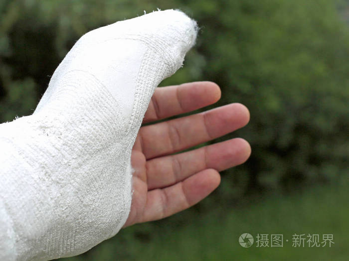 拇指方阵骨折后受伤者手受伤照片-正版商用图片04zdjp