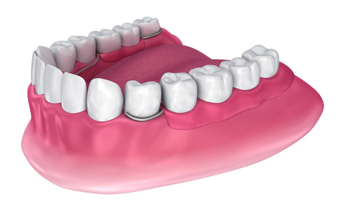 可拆卸部分义齿。医学上精确的3d 例证